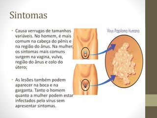 Sintomas
• Causa verrugas de tamanhos
variáveis. No homem, é mais
comum na cabeça do pênis e
na região do ânus. Na mulher,
os sintomas mais comuns
surgem na vagina, vulva,
região do ânus e colo do
útero;
• As lesões também podem
aparecer na boca e na
garganta. Tanto o homem
quanto a mulher podem estar
infectados pelo vírus sem
apresentar sintomas.
 