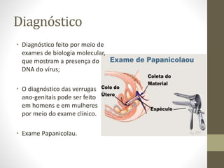 Diagnóstico
• Diagnóstico feito por meio de
exames de biologia molecular,
que mostram a presença do
DNA do vírus;
• O diagnóstico das verrugas
ano-genitais pode ser feito
em homens e em mulheres
por meio do exame clínico.
• Exame Papanicolau.
 