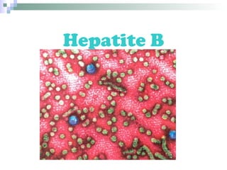Hepatite B
 