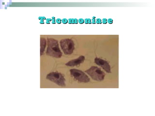 TricomoníaseTricomoníase
 