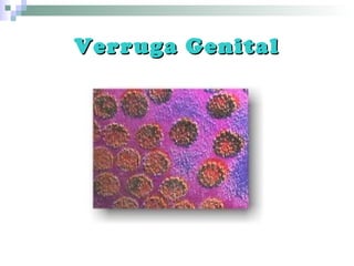 Verruga GenitalVerruga Genital
 