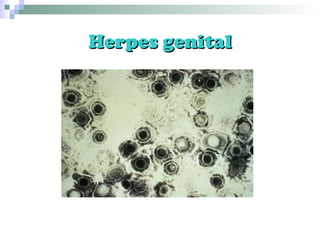 Herpes genital 