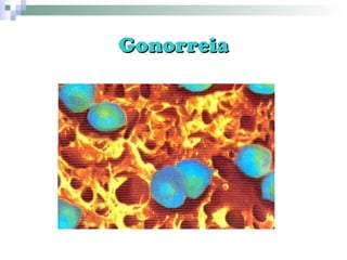 Gonorreia 