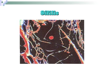 Sífilis 