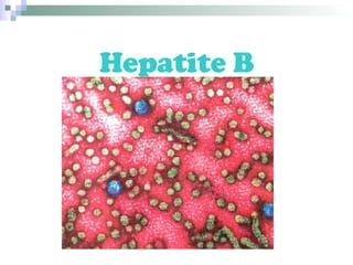 Hepatite B 