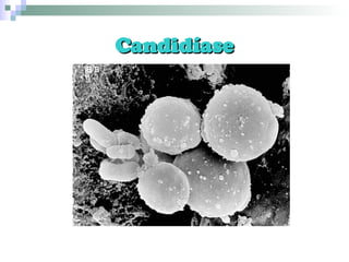 Candidíase 