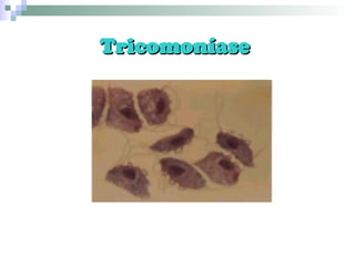 Tricomoníase  