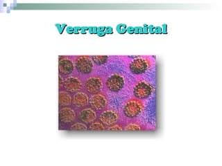 Verruga Genital 