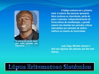 A fadiga costuma ser o primeiro sinal. A maioria das pessoas apresenta febre contínua ou intermitente, perda de peso e mal-estar. Independentemente da forma clínica de manifestação, a grande maioria dos doentes tem períodos críticos intercalados por períodos de relativa melhora ou mesmo de inactividade. 	Lady Gaga, Michael Jackson e Seal são algumas das pessoas que têm esta doença. As marcas na cara do cantor Seal foram causadas pela sua doença.Lúpus Eritematoso Sistémico