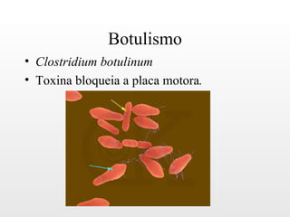 Botulismo
• Clostridium botulinum
• Toxina bloqueia a placa motora.
 