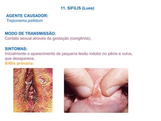 11. SIFILIS (Lues)
AGENTE CAUSADOR:
Treponema pallidum
MODO DE TRANSMISSÃO:
Contato sexual através da gestação (congênita).
SINTOMAS:
Inicialmente o aparecimento de pequena lesão indolor no pênis e vulva,
que desaparece.
Sifilis primária:
 
