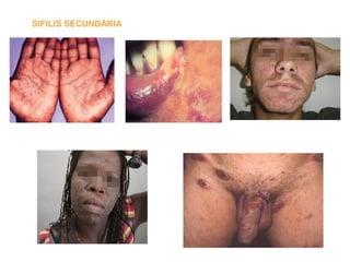 SIFILIS SECUNDÁRIA
 