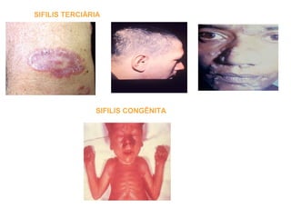 SIFILIS TERCIÁRIA
SIFILIS CONGÊNITA
 