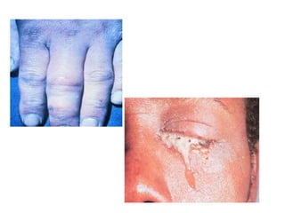 Doenças bacterianas