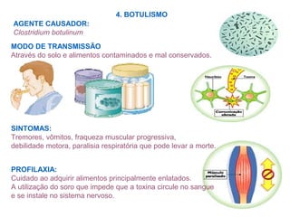 4. BOTULISMO
AGENTE CAUSADOR:
Clostridium botulinum
MODO DE TRANSMISSÃO
Através do solo e alimentos contaminados e mal conservados.
SINTOMAS:
Tremores, vômitos, fraqueza muscular progressiva,
debilidade motora, paralisia respiratória que pode levar a morte.
PROFILAXIA:
Cuidado ao adquirir alimentos principalmente enlatados.
A utilização do soro que impede que a toxina circule no sangue
e se instale no sistema nervoso.
 
