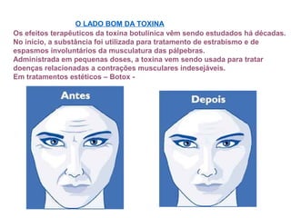 Os efeitos terapêuticos da toxina botulínica vêm sendo estudados há décadas.
No início, a substância foi utilizada para tratamento de estrabismo e de
espasmos involuntários da musculatura das pálpebras.
Administrada em pequenas doses, a toxina vem sendo usada para tratar
doenças relacionadas a contrações musculares indesejáveis.
Em tratamentos estéticos – Botox -
O LADO BOM DA TOXINA
 