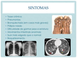 SINTOMAS
• Tosse crônica;
• Pneumonias;
• Bronquiectasia (em casos mais graves);
• Pólipos nasais;
• Dificuldade de ganhar peso e estatura;
• Movimentos intestinais anormais;
• Suor mais salgado que o normal;
• Baqueteamento.
 