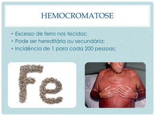 HEMOCROMATOSE
• Excesso de ferro nos tecidos;
• Pode ser hereditária ou secundária;
• Incidência de 1 para cada 200 pessoas;
 