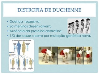 DISTROFIA DE DUCHENNE
• Doença recessiva;
• Só meninos desenvolvem;
• Ausência da proteína destrofina;
• 1/3 dos casos ocorre por mutação genética nova.
 