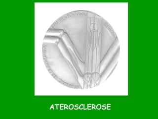 ATEROSCLEROSE 