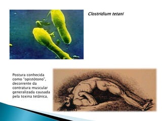 Clostridium tetani
Postura conhecida
como “opistótono”,
decorrente da
contratura muscular
generalizada causada
pela toxina tetânica.
 