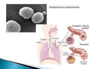 Streptococcus pneumoniae
 