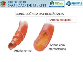 CONSEQUÊNCIA DA PRESSÃO ALTA
Artéria normal
“Artéria entupida.“
Artéria com
aterosclerose
 