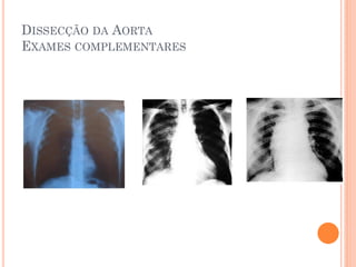 DISSECÇÃO DA AORTA
EXAMES COMPLEMENTARES
 