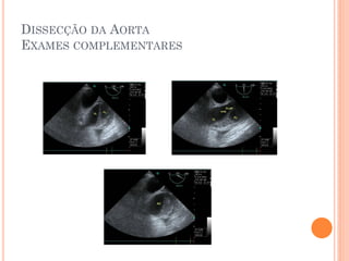 DISSECÇÃO DA AORTA
EXAMES COMPLEMENTARES
 