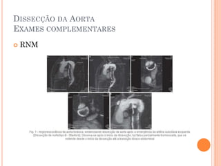 DISSECÇÃO DA AORTA
EXAMES COMPLEMENTARES
   RNM
 