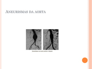 ANEURISMAS DA AORTA
 