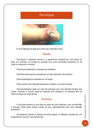 14
DoençasdasUnhas|01/01/2013
Paroníquia
É uma infecção da pele que ocorre por volta das unhas.
Causas
Paroníquia é bastante comum e é geralmente causada por uma lesão na
área, por exemplo, de morder ou escolher uma unha encravada (padrasto) ou de
corte ou empurrar a cutícula.
Paroníquia bacteriana é causada por bactérias.
Cândidas paroníquia é causada por um tipo específico de levedura.
Paroníquiafúngica é causada por um fungo.
Pode ocorrer uma infecção bacteriana e fúngica, ao mesmo tempo.
Paroníquiafúngica pode ser visto em pessoas com uma infecção fúngica das
unhas. Também é comum entre as pessoas com diabetes e as pessoas têm as
mãos na água por muito tempo.
Sintomas
O principal sintoma é uma área ao redor da unha dolorosa, com vermelhidão
e inchaço. Pode haver bolhas cheias de pus, especialmente com uma infecção
bacteriana.
As bactérias causam a doença de forma aguda. A infecção causada por um
fungo tende a ocorrer mais lentamente.
 