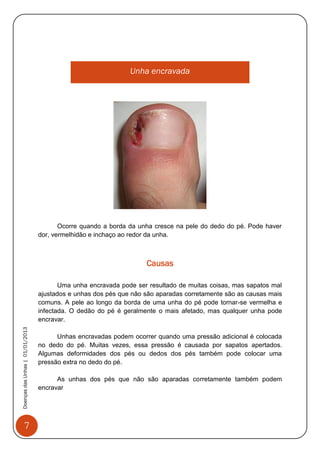 7
DoençasdasUnhas|01/01/2013
Unha encravada
Ocorre quando a borda da unha cresce na pele do dedo do pé. Pode haver
dor, vermelhidão e inchaço ao redor da unha.
Causas
Uma unha encravada pode ser resultado de muitas coisas, mas sapatos mal
ajustados e unhas dos pés que não são aparadas corretamente são as causas mais
comuns. A pele ao longo da borda de uma unha do pé pode tornar-se vermelha e
infectada. O dedão do pé é geralmente o mais afetado, mas qualquer unha pode
encravar.
Unhas encravadas podem ocorrer quando uma pressão adicional é colocada
no dedo do pé. Muitas vezes, essa pressão é causada por sapatos apertados.
Algumas deformidades dos pés ou dedos dos pés também pode colocar uma
pressão extra no dedo do pé.
As unhas dos pés que não são aparadas corretamente também podem
encravar
 