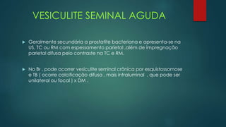 VESICULITE SEMINAL AGUDA
 Geralmente secundária a prostatite bacteriana e apresenta-se na
US, TC ou RM com espessamento parietal ,além de impregnação
parietal difusa pelo contraste na TC e RM.
 No Br , pode ocorrer vesiculite seminal crônica por esquistossomose
e TB ( ocorre calcificação difusa , mais intraluminal , que pode ser
unilateral ou focal ) x DM .
 