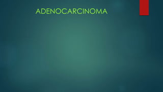 ADENOCARCINOMA
 