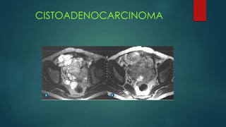 CISTOADENOCARCINOMA
 