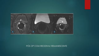 PÓS OP COM RECIDIVA/ REMANESCENTE
 