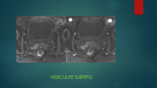 VESICULITE SUBTIPO
 
