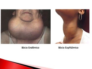 Bócio Endêmico   Bócio Expftálmico
 