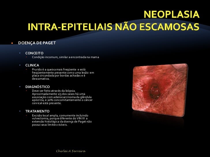 Como retirar um fungo de um prego