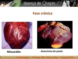 Fase crônica
Aneurisma de ponta
Epidemiologia Professor: Msc. Márcio Silva Itaituba 2014
Miocardite
 