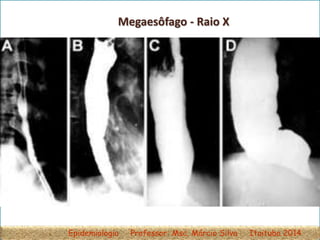 Megaesôfago - Raio X
Classificação radiológica do megaesôfago em quatro grupos, conforme a evolução da afecção.
Epidemiologia Professor: Msc. Márcio Silva Itaituba 2014
 