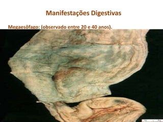 Manifestações Digestivas
Megaesôfago: (observado entre 20 e 40 anos).
 