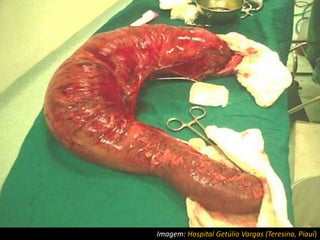 Megacólon Chagásico
Imagem: Hospital Getúlio Vargas (Teresina, Piauí)
 