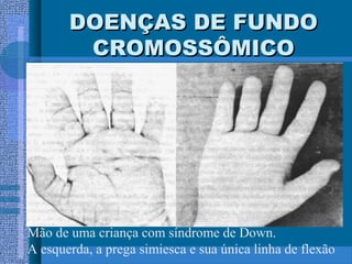 DOENÇAS DE FUNDODOENÇAS DE FUNDO
CROMOSSÔMICOCROMOSSÔMICO
Mão de uma criança com síndrome de Down.
A esquerda, a prega simiesca e sua única linha de flexão
 