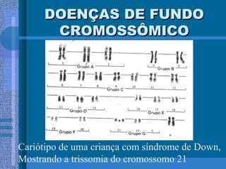 DOENÇAS DE FUNDODOENÇAS DE FUNDO
CROMOSSÔMICOCROMOSSÔMICO
Cariótipo de uma criança com síndrome de Down,
Mostrando a trissomia do cromossomo 21
 