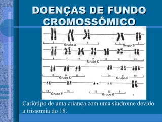 DOENÇAS DE FUNDODOENÇAS DE FUNDO
CROMOSSÔMICOCROMOSSÔMICO
Cariótipo de uma criança com uma síndrome devido
a trissomia do 18.
 
