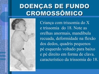 DOENÇAS DE FUNDODOENÇAS DE FUNDO
CROMOSSÔMICOCROMOSSÔMICO
Criança com trissomia do X
e trissomia do 18. Note as
orelhas anormais, mandíbula
recuada, deformidade na flexão
dos dedos, quadris pequenos
pé esquerdo voltado para baixo
e pé direito em forma de clava.
característico da trissomia do 18.
 