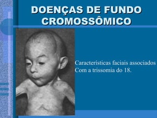 DOENÇAS DE FUNDODOENÇAS DE FUNDO
CROMOSSÔMICOCROMOSSÔMICO
Características faciais associados
Com a trissomia do 18.
 