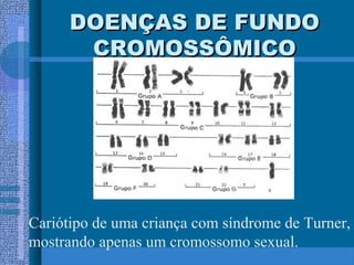 DOENÇAS DE FUNDODOENÇAS DE FUNDO
CROMOSSÔMICOCROMOSSÔMICO
Cariótipo de uma criança com síndrome de Turner,
mostrando apenas um cromossomo sexual.
 